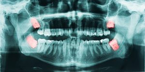 wisdom tooth extraction x-ray